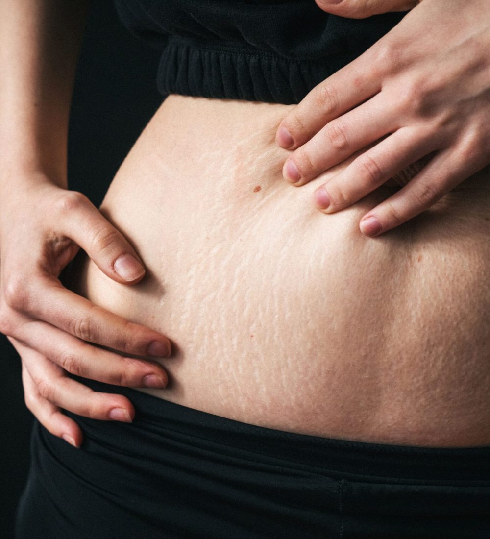 close-up-of-female-showing-stretch-marks-women-b-2025-01-09-12-38-49-utc (1) (1)
